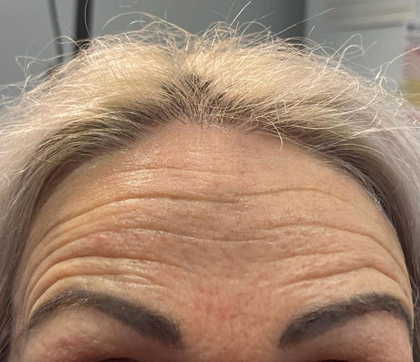 Before-facethree