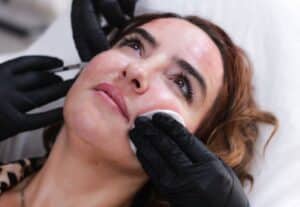 derma fillers